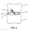 Fig. 04 - Flexible anchoring and fusion devices and methods of using the same