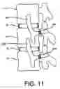Fig. 09 - Flexible anchoring and fusion devices and methods of using the same