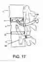 Fig. 13 - Flexible anchoring and fusion devices and methods of using the same