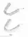 Fig. 02 - Sequential mouth guard