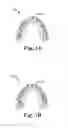 Fig. 02 - Virtually testing force placed on a tooth