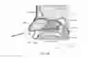 Fig. 32 - Method of performing a sphenopalatine ganglion block procedure