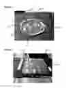 Fig. 02 - Tissue Debris and Blood Collection Device and Methods of Use Thereof