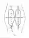 Fig. 02 - Line-shaped paw-type patella external fixator