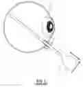 Fig. 02 - VARIABLE-GAUGE MICROSURGICAL INSTRUMENTS FOR USE IN OPHTHALMIC OR VITREORETINAL SURGERY