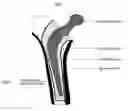Fig. 01 - Method and apparatus to control the heterogeneous flow of bone cement and improve osseointegration of cemented implant