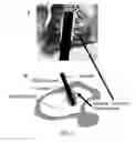 Fig. 02 - Method and apparatus to control the heterogeneous flow of bone cement and improve osseointegration of cemented implant