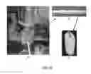 Fig. 10 - Method and apparatus to control the heterogeneous flow of bone cement and improve osseointegration of cemented implant