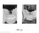 Fig. 12 - Method and apparatus to control the heterogeneous flow of bone cement and improve osseointegration of cemented implant