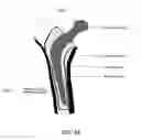 Fig. 17 - Method and apparatus to control the heterogeneous flow of bone cement and improve osseointegration of cemented implant