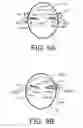 Fig. 13 - Hearing assistance device comprising an implantable part