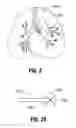 Fig. 03 - Induced atelectasis and pulmonary consolidation systems and methods
