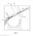 Fig. 08 - Methods of fixating tissue to bone