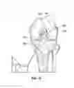 Fig. 09 - Methods of fixating tissue to bone