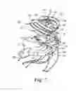 Fig. 08 - Subxiphoid connective lesion ablation system and method