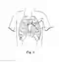 Fig. 09 - Subxiphoid connective lesion ablation system and method