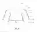 Fig. 09 - Tooth-positioning appliance for closing spaces