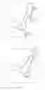 Fig. 05 - Microanchors for knotless tissue repair