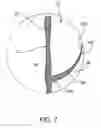 Fig. 09 - Prosthetic heart valve formation