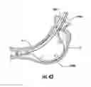 Fig. 26 - Devices and methods for facilitating sleeve gastrectomy procedures
