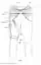 Fig. 29 - Orthopedic device for treating complications of the hip