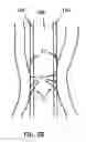 Fig. 05 - Enteral feeding system with controlled reflux preventive vacuum sealing