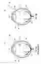 Fig. 07 - Planar illuminator for ophthalmic surgery