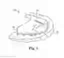Fig. 02 - Arch expanding appliance