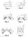 Fig. 02 - Prosthetic heart valve devices and methods of valve replacement