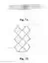 Fig. 07 - LUMINAL IMPLANT FOR THE CORRECTION OF OCCLUSIONS