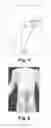 Fig. 02 - Wearable noxipoints stimulating devices