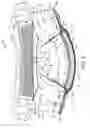 Fig. 06 - Absorbent article with selectively positioned waist containment member