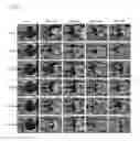 Fig. 08 - Use of statins in the treatment of ischemic diseases
