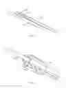 Fig. 07 - SYSTEMS AND METHODS FOR REVERSIBLE NERVE BLOCK TO  RELIEVE DISEASE SYMPTOMS