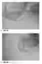 Fig. 12 - Formed thermoplastic article having a peelable surface and smooth edges