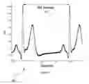 Fig. 07 - R-R interval measurement using multi-rate ECG processing