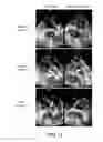 Fig. 11 - Method and apparatus for treating valvular disease