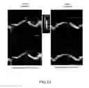 Fig. 13 - Method and apparatus for treating valvular disease