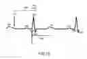 Fig. 17 - Method and apparatus for treating valvular disease