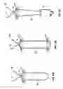 Fig. 13 - Adjustable suture knot