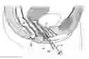 Fig. 01 - Surgical instrument