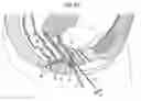 Fig. 03 - Surgical instrument