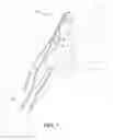 Fig. 02 - Bifurcated forceps