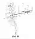 Fig. 25 - Percutaneous lateral recess resection methods and instruments