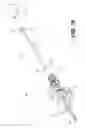 Fig. 26 - Percutaneous lateral recess resection methods and instruments