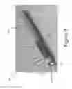 Fig. 04 - DUAL END SYSTEMS AND METHODS FOR CROSSING AND TREATING AN OCCLUSION