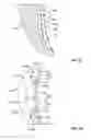 Fig. 08 - Orthopedic augments having recessed pockets