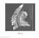 Fig. 10 - Polyaryletherketone artificial intervertebral disc