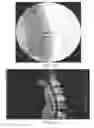 Fig. 11 - Polyaryletherketone artificial intervertebral disc