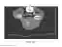 Fig. 12 - Polyaryletherketone artificial intervertebral disc